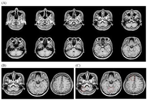 Adaptive RAG-Assisted MRI Platform (ARAMP) for Brain Metastasis ...