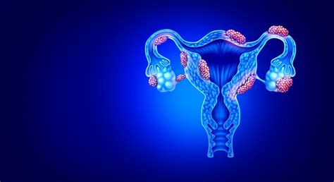 Endometriosis & Infertility: Symptoms, Stages & Treatment | Motherhood ...