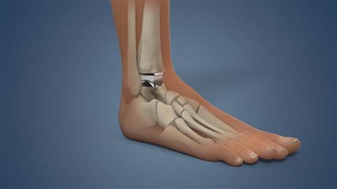 Ankle Fusion vs. Replacement: Which Is Right for You? - HealthEH.com