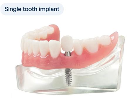 Can I get a tooth pulled and a dental implant the same day? | ClearChoice