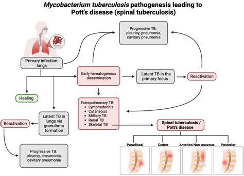 Pathogenesis and Clinical Presentation of Pott’s Disease | Encyclopedia ...