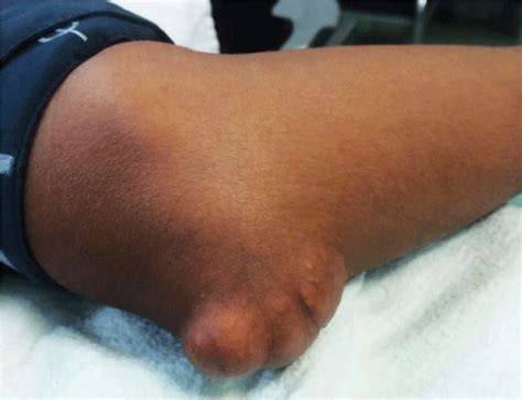 Xanthoma eye, tendinous, tuberous and disseminatum causes & treatment
