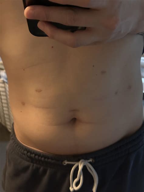 Nissen Fundoplication Scar