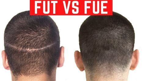 Hair Scar repair, Hair surgery scars, Hair Transplant Scar Revision FUE FUT