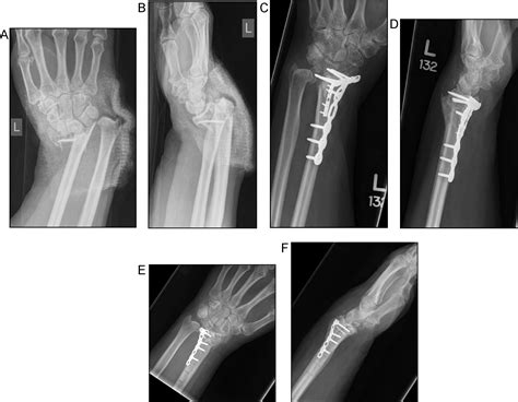 Safety of immediate open reduction and internal fixation of geriatric ...