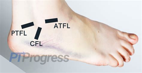 Lateral Ankle Sprain: How to Treat at Home