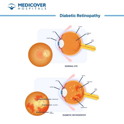 Diabetic Retinopathy: Types, Indications, Procedure, Risks & Benefits