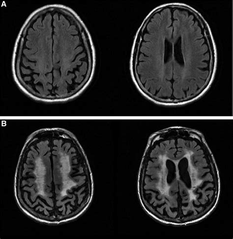 small vessel disease symptoms Moderate chronic small vessel ischemic disease - Diseases Club ...