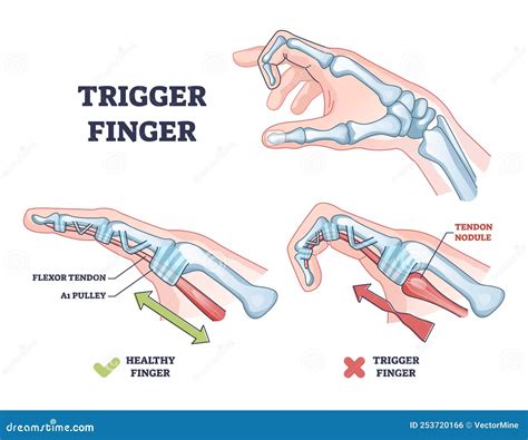 Fingers Locked Concussion at Ashley Pines blog