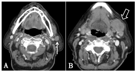 Beyond Ultrasound: Multimodal Cross-Sectional Imaging for Preoperative Imaging of Parotid Gland ...