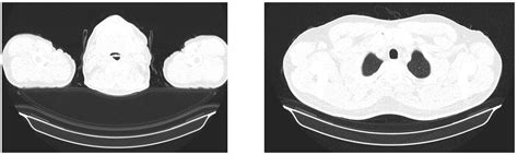 Classification of Pulmonary Damage Stages Caused by COVID-19 Disease ...