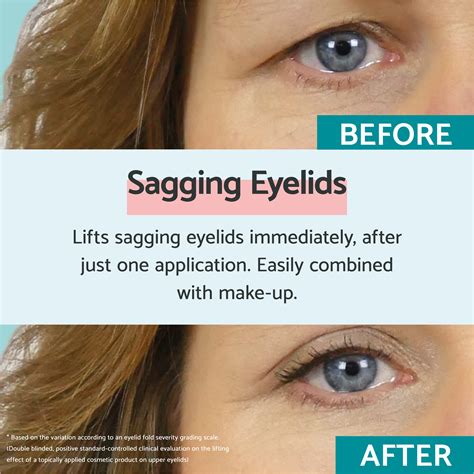 Saggy Eyelids Treatments For Droopy Eyelids In Costa Rica Ptosis