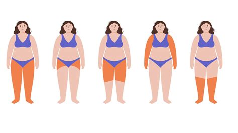 Los secretos del lipedema: una enfermedad que afecta la distribución de la grasa corporal - El ...