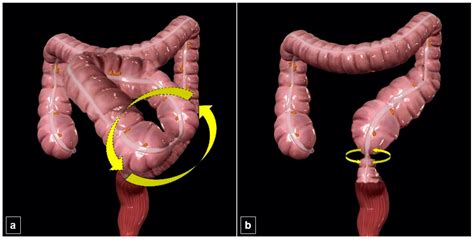 Relationship Between Sigmoid Volvulus Subtypes, Clinical Course, and ...
