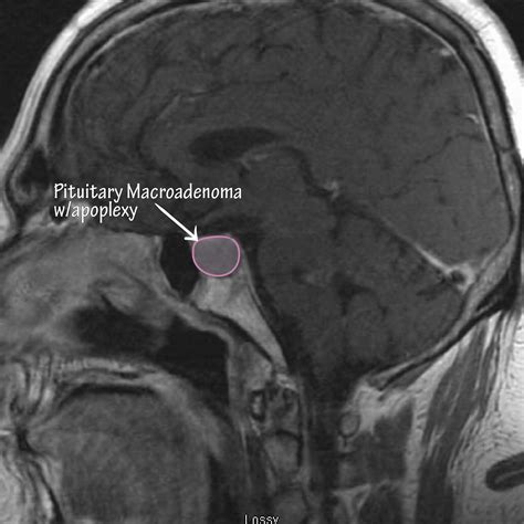 Pituitary Adenoma Mri Pituitary Tumor North American