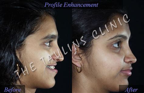 Facial Deformity Correction Bangalore, INDIA