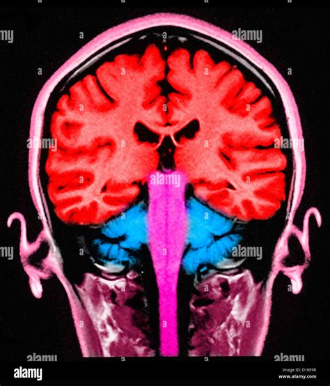 Normal brain mri hi-res stock photography and images - Alamy