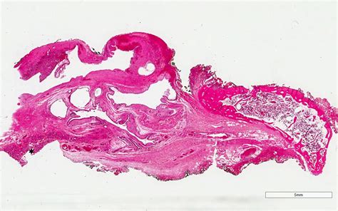 Pathology Outlines - Thyroglossal duct cyst