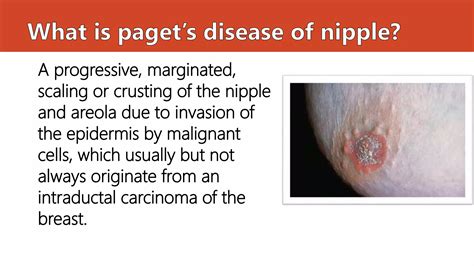 Paget's disease | PPTX