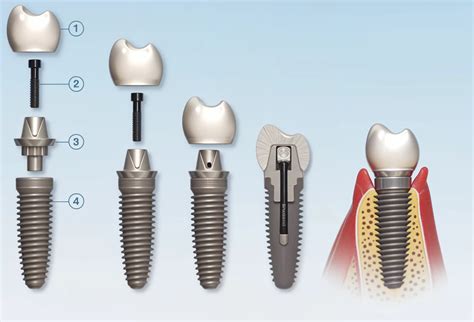 Dental Implant Parts - Key Component and Uses | AO Dentistry