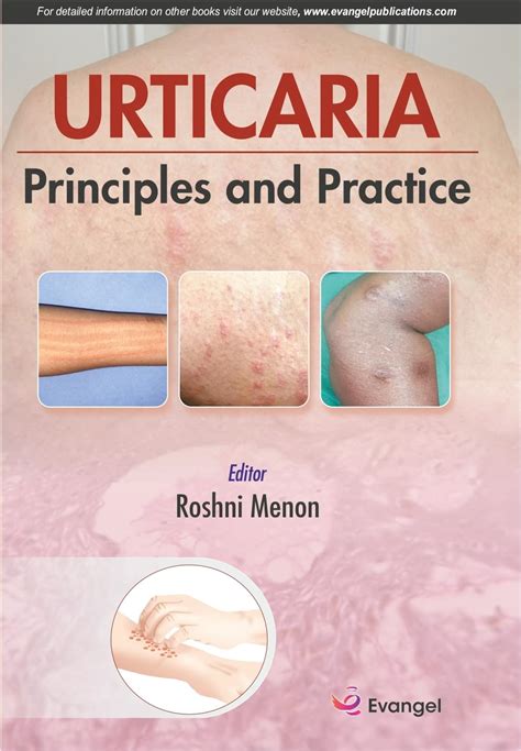 Buy Urticaria Principal and Practice Book Online at Low Prices in India ...