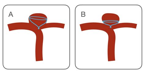 Intrasaccular Flow Disruptor-Assisted Coiling of Intracranial Aneurysms ...