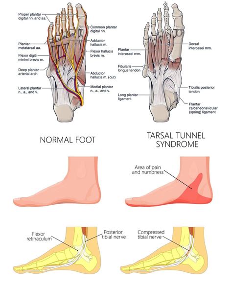 Running Foot Numbness: EP Sciatica Clinic