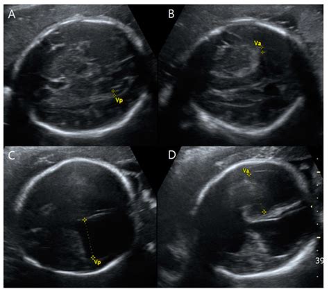 Nonfamilial VACTERL-H Syndrome in a Dizygotic Twin: Prenatal Ultrasound ...