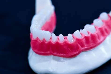Veneers Process & Shaving Explained | St. George Dental Care