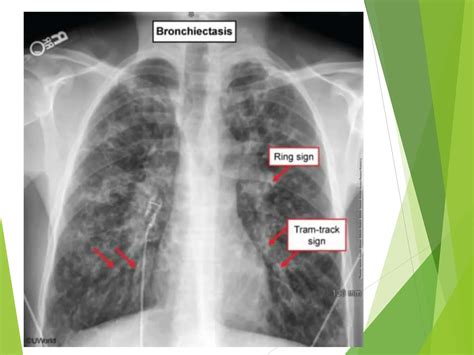 Diagnosis and Imaging of Bronchiectasis.ppt