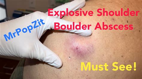 Image result for Giant Abscess Exploding On Back