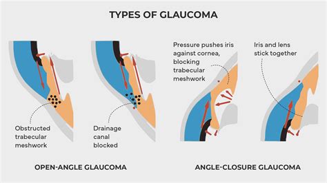 Understanding Glaucoma: Symptoms, Causes, Treatments | Atlus