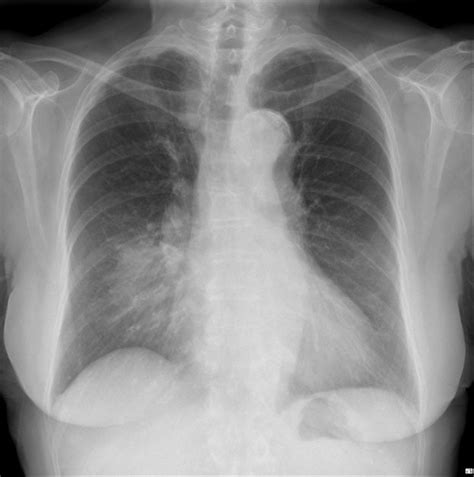 right middle lobe pneumonia