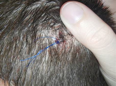 Scalp Parasites 的图像结果