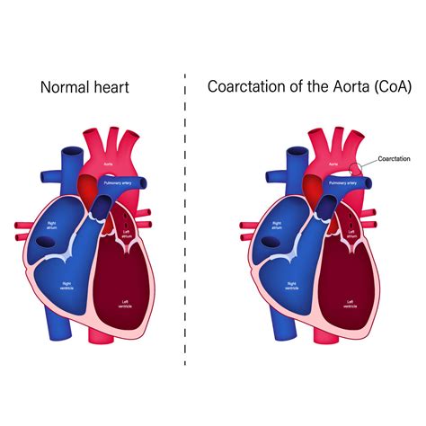 Top 9 Warning Signs of Aortic Coarctation | Vejthani