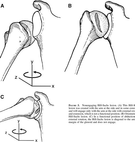 Hill-Sachs defect • LITFL • Medical Eponym Library - Face Surgery