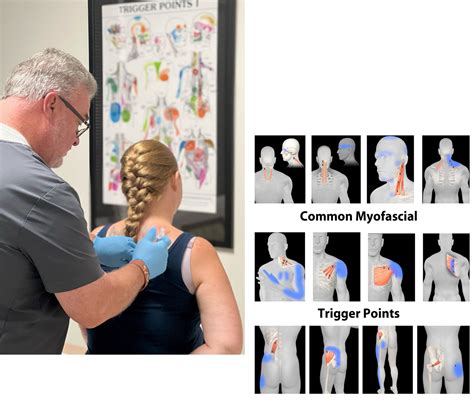TRIGGER POINT INJECTIONS - Coastal Virginia Spine & Pain Center