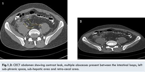 Early Operative Treatment for an Enterocutaneous Fistula after Gunshot ...