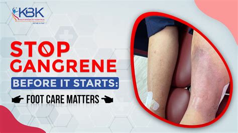 Cellulitis Symptoms : Early Warning Signs You Shouldn't Ignore