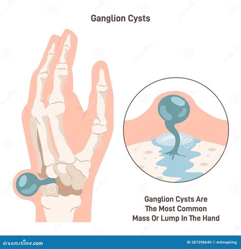 Lump Under Skin Near Wrist at Daria Willis blog
