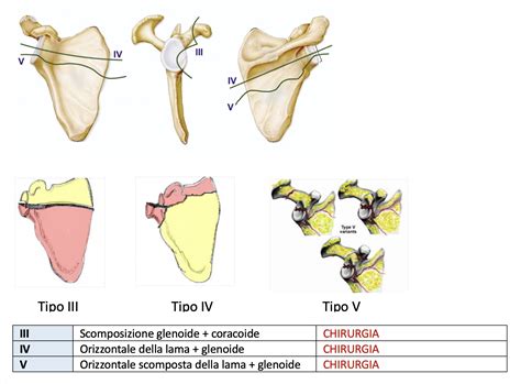 Frattura della scapola - LG