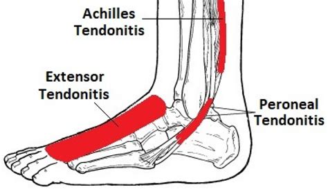 Image result for Extensor Tendonitis Stretches