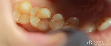 一例急性牙髓炎一次性根管治疗-爱尚牙医li的博客-KQ88口腔博客