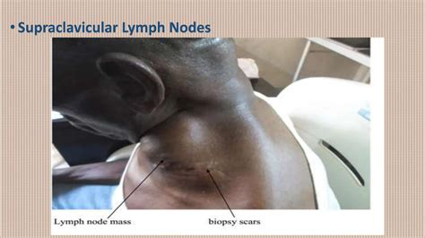 non-hodgkin's disease , cancer , acute and exarberation | PPTX