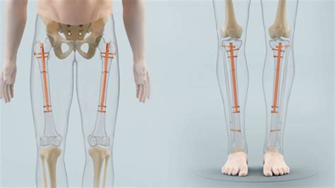 Leg Lengthening Surgery: Everything You Need To Know