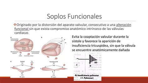 Soplos cardiacos | PPTX
