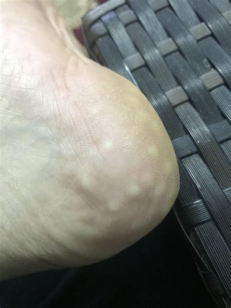 What are these bumps on my foot sole? : r/medical