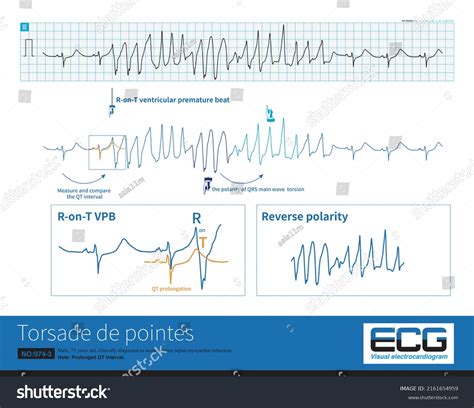 torsades de pointes 心電図, 頻拍性不整脈 心電図 – ASXQLU