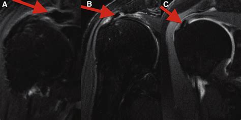 Calcific Tendonitis of the Shoulder: Protector or Predictor of Cuff Pathology? A Magnetic ...