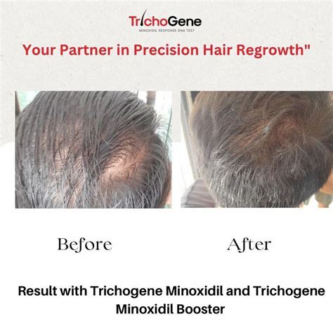 Minoxidil Booster - 0.1% Trichogene Minoxyboost Minoxidil Booster ...
